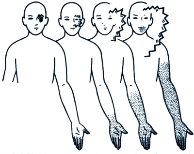 Visual aura with scintillating scotoma (above) and somatosensory aura with digitolingual syndrome (below), shown in successive stages of development from left to right.
