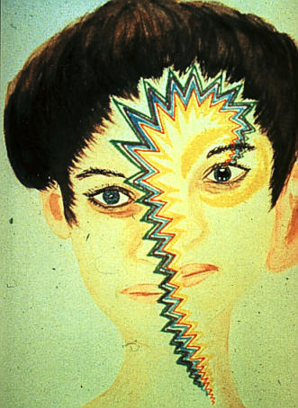 Medical illustration of diplopia (double vision) — a visual illusion that can occur as a transitory aura symptom.