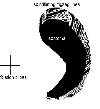 Fortification spectrum, reproduced from a computational model. The zigzag arc expands outward from the centre of vision.